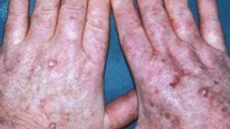 Actinische keratose