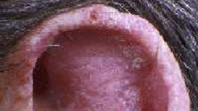 Actinische keratose