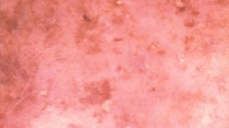 Actinische keratose