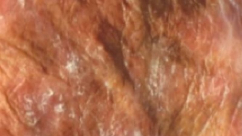 Actinische keratose