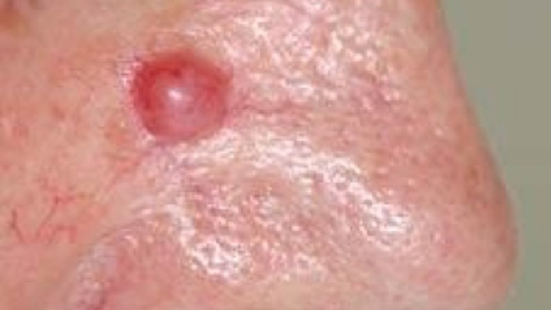 Basaalcelcarcinoom