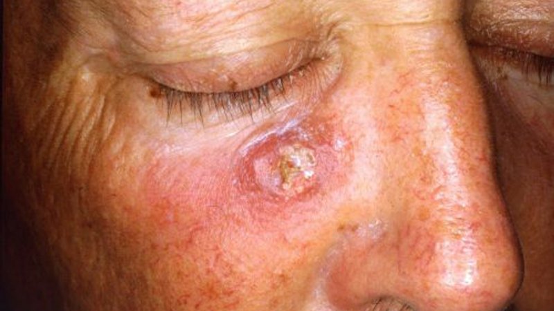 Plaveiselcelcarcinoom