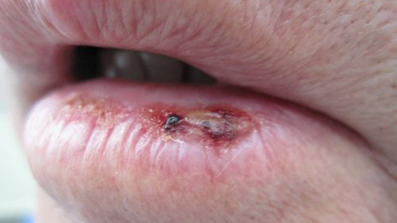 Plaveiselcelcarcinoom