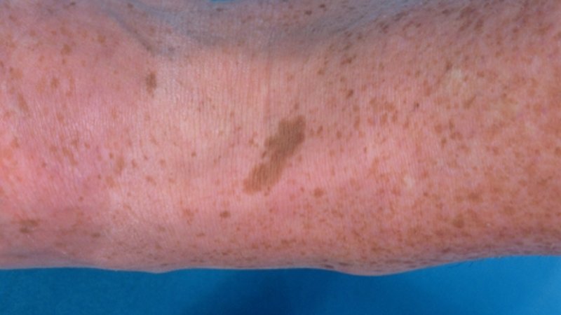Rimpels en sproeten door UV-schade