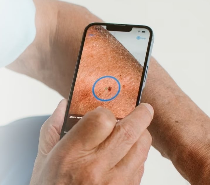 SkinVision huidcheck actie - Tijdelijk verlengd: aanmelden kan t/m 30 juni 2026