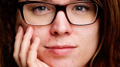 Ervaring met acne - het verhaal van Deirdre